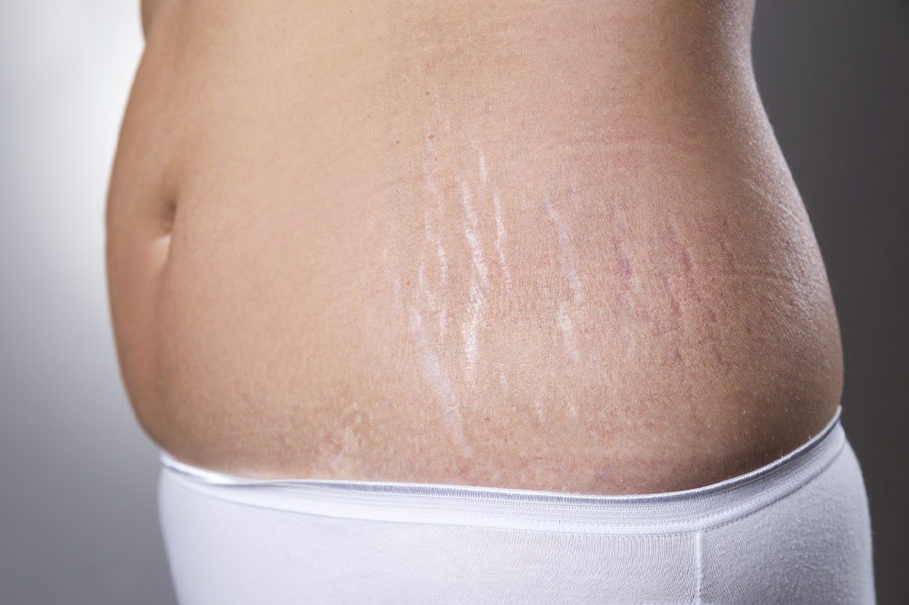 5 Types of Plastic Surgeries for Stretch Marks